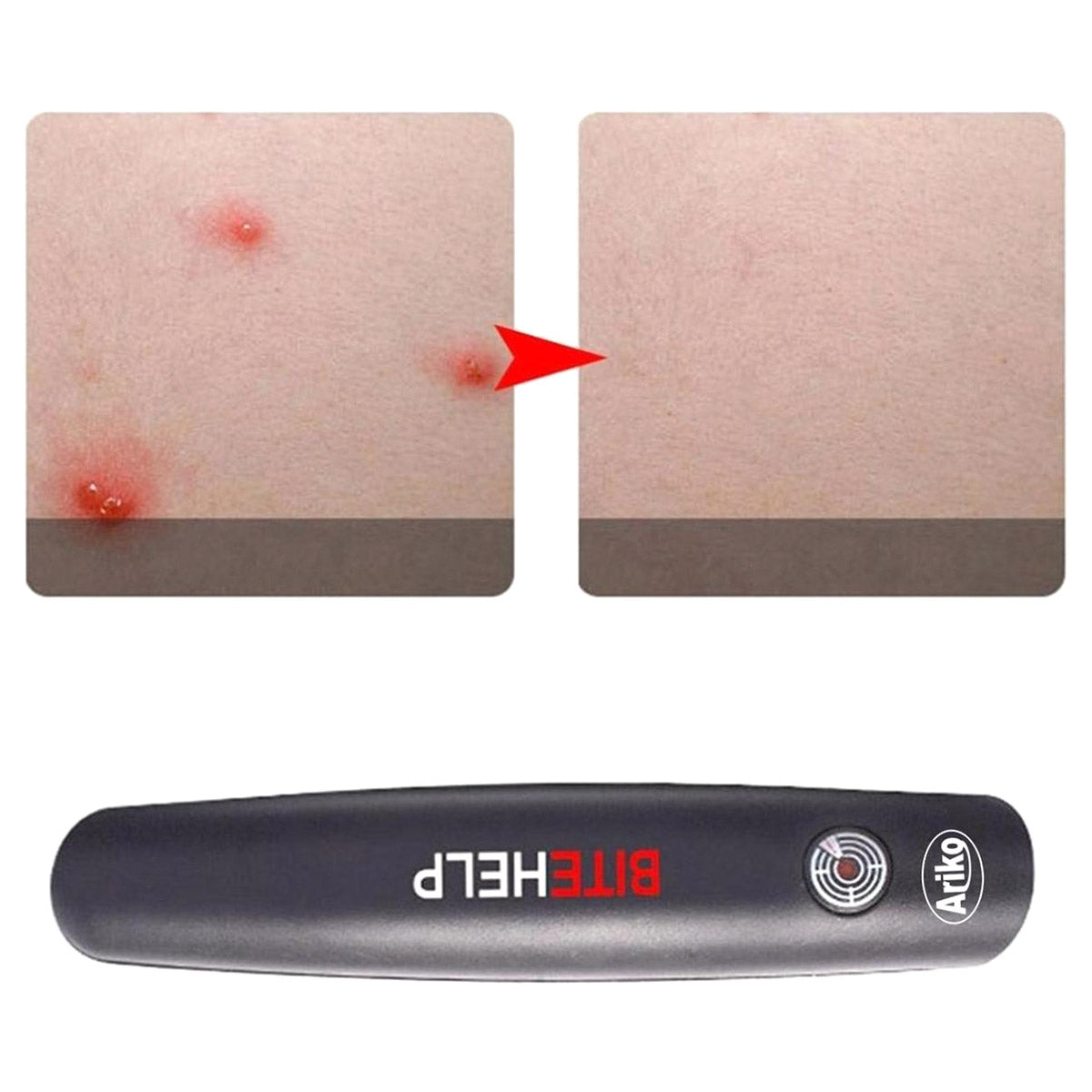 Ariko Bite Help Mückenstich Stift Insektenstich Schmerzlinderung Juckreiz lindern Mückenstift Mückenstich Mückenstich